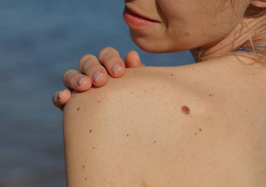 Выявить злокачественные заболевания кожи по фотографии: сервис ПроРодинки при поддержке Санофи